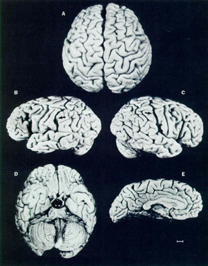 einsteins brain (Lancet)