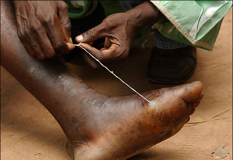 guinea worm1